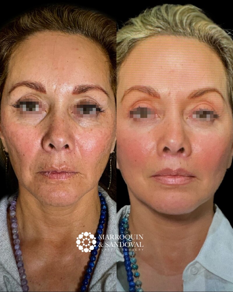 Before and After Result